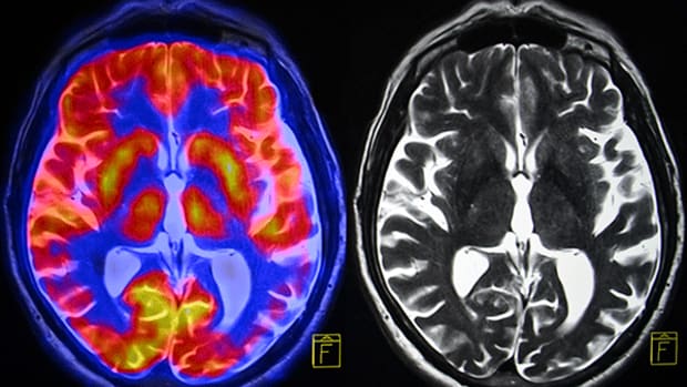 Neurotrope Spins a Failed Alzheimer's Drug Study