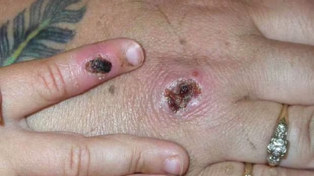 Monkeypox causes lesions that resemble pus-filled blisters, which eventually scab over. CDC/Getty Images
