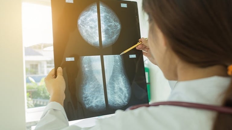 Breast cancer diagnosis by AI now as good as human experts
