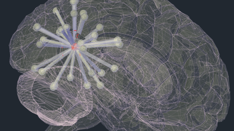 How Alzheimer’s disease spreads throughout the brain – new study